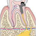 granuloma.jpg