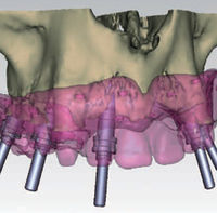 implantologia_guidata_sorriso_01.jpg